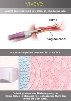 viveve treatment viveve treatment
